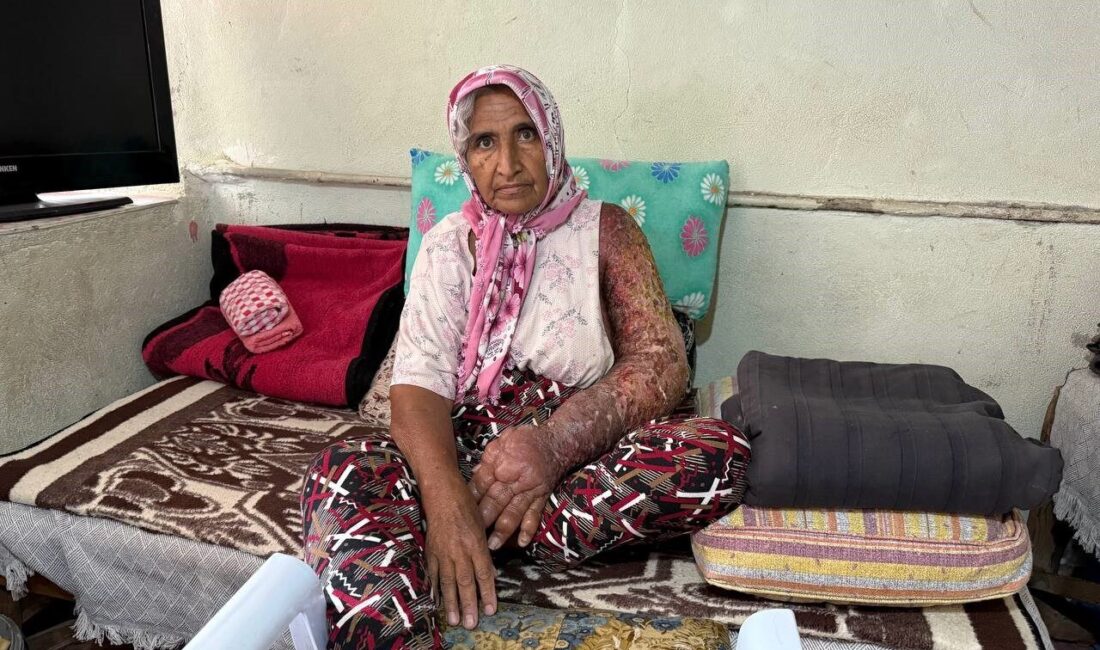 Kolu şişti, vücuduna kadar yara oldu: 4 çocuk annesinin zorlu yaşamı Adana’da 4 çocuk annesinin 8 yıl önce başlayan rahatsızlığı nedeniyle