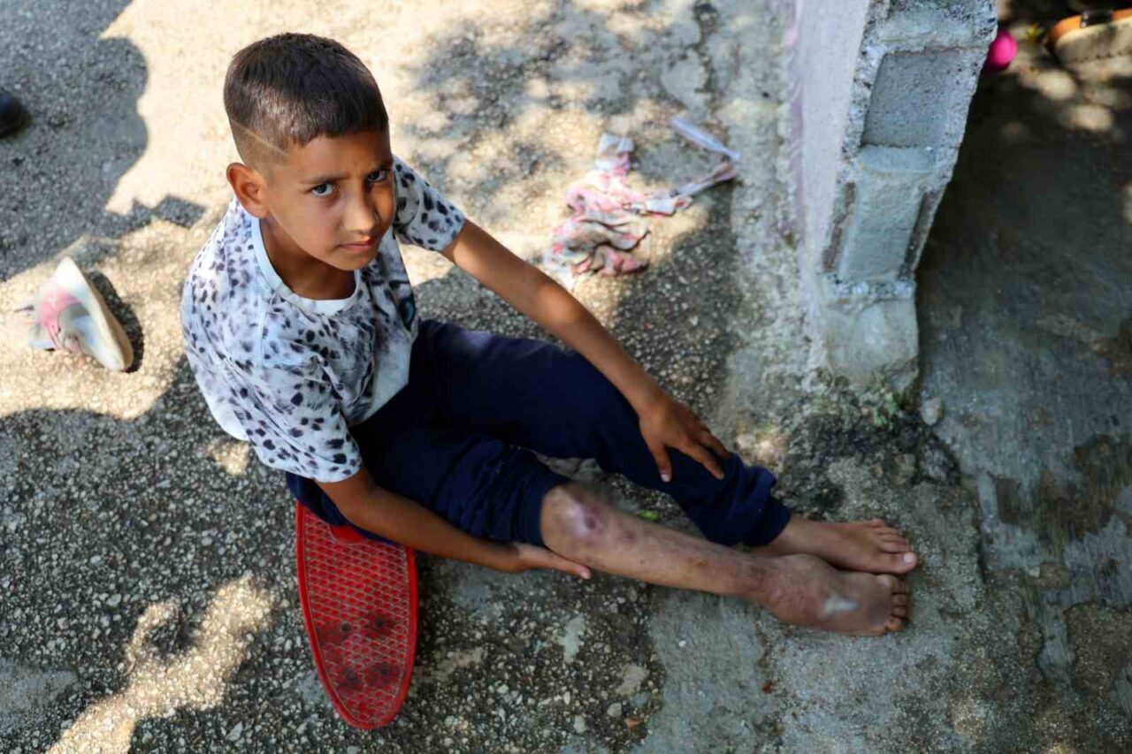 Adana’da ayağındaki kemik yanlış kaynadığı için yürüyemeyen 11 yaşındaki Serdal,