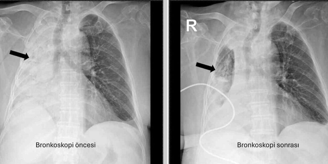 Denizli’de 78 yaşındaki felçli hastanın nefes borusuna kaçan mısır tanesi