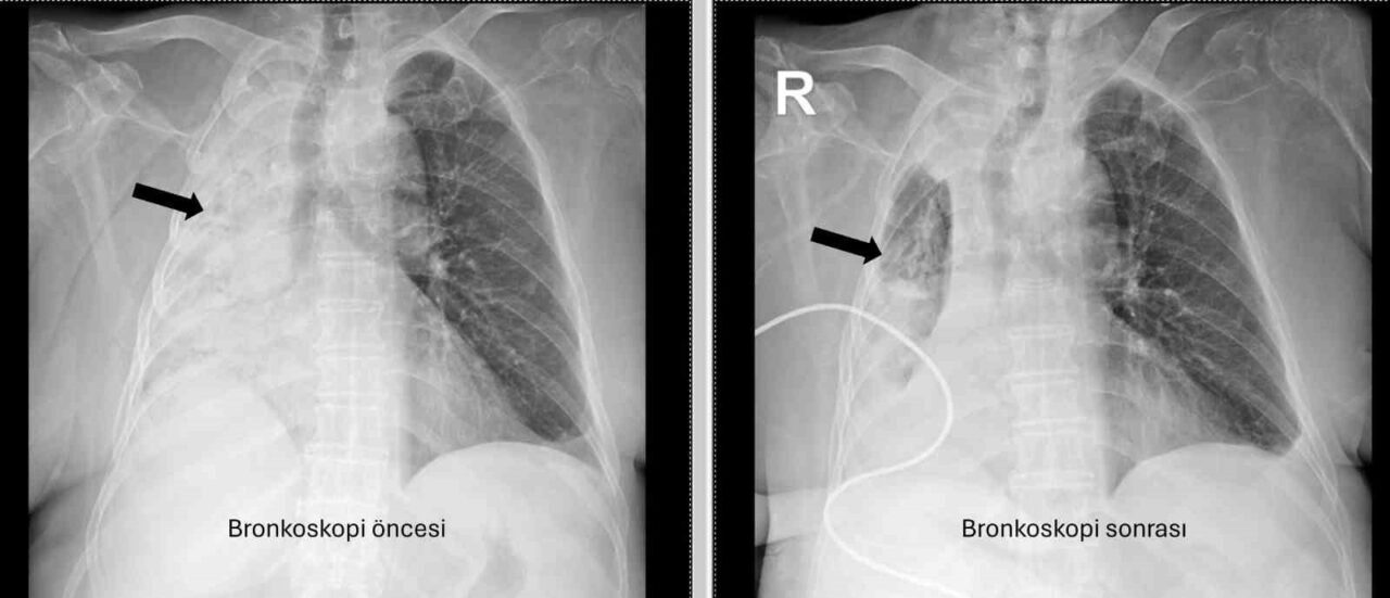 Denizli’de 78 yaşındaki felçli hastanın nefes borusuna kaçan mısır tanesi