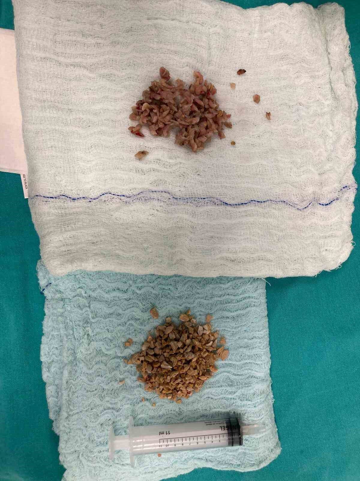 Bayburt Devlet Hastanesi Üroloji Polikliniğine başvuran 84 yaşındaki hastaya, prostat