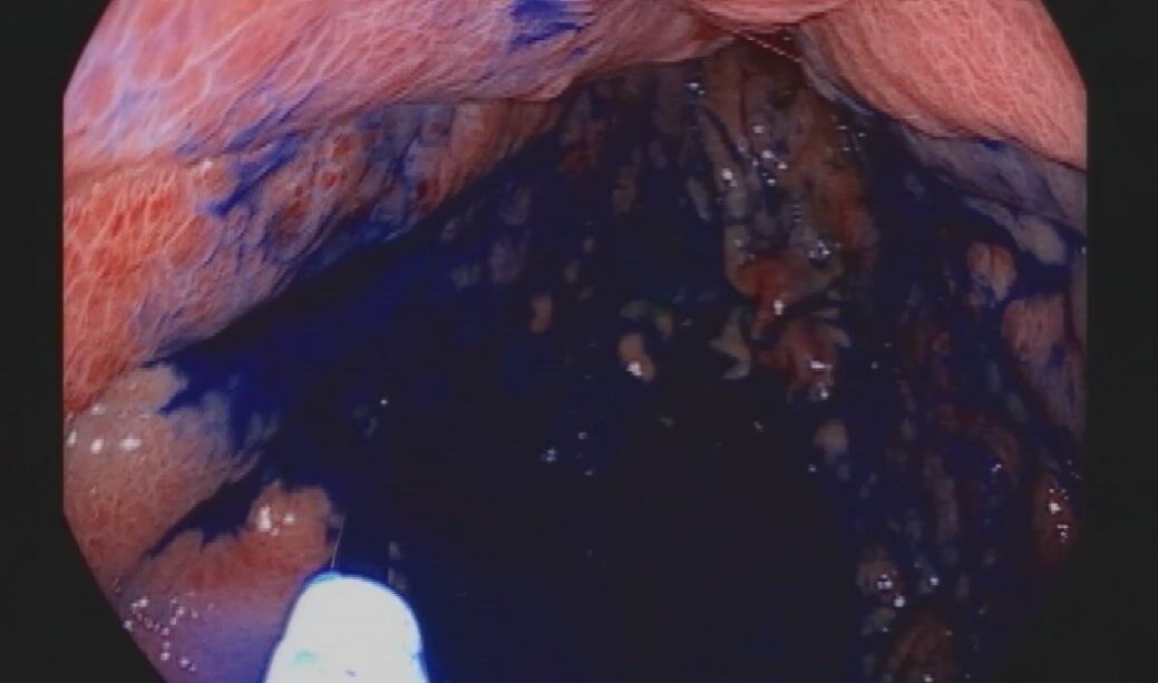 Mide ve bağırsak kanserlerinde erken teşhisin önemini hatırlatan Genel Cerrahi
