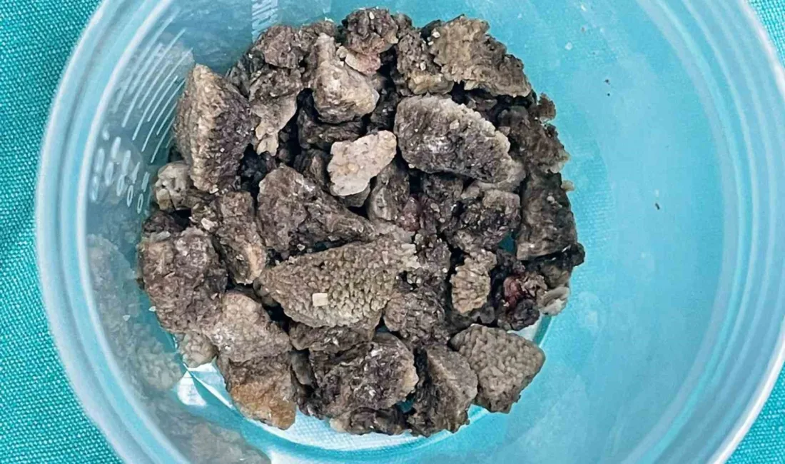 Malatya Eğitim ve Araştırma Hastanesi’nde 58 yaşındaki Ülkü Sabaner’in böbreğini