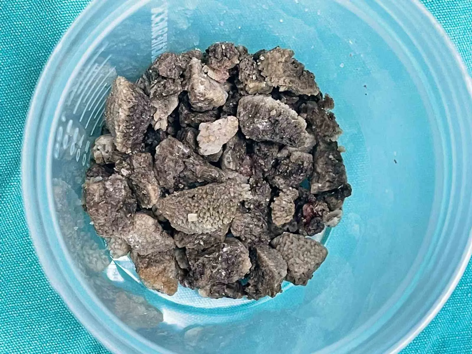 Malatya Eğitim ve Araştırma Hastanesi’nde 58 yaşındaki Ülkü Sabaner’in böbreğini