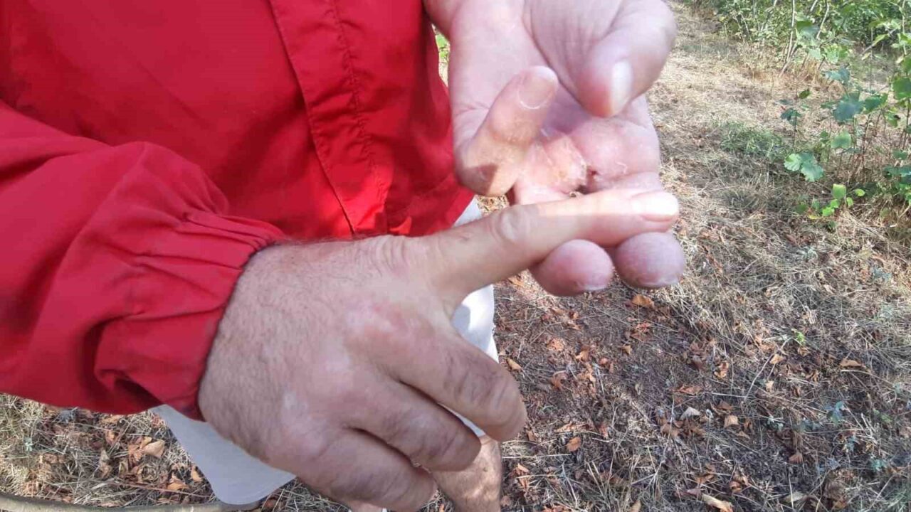 Bolu’nun Mudurnu ilçesinde fındık bahçesinde ayının saldırdığı kişi, bir parmağını