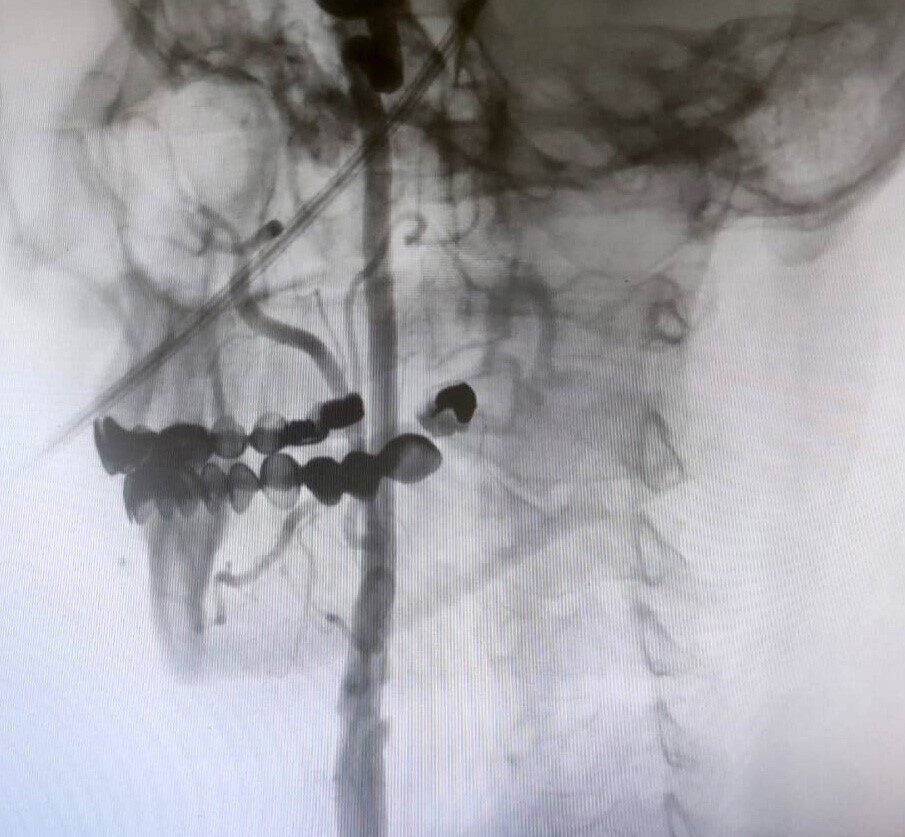 Manisa Şehir Hastanesi’nde, beyin damarlarındaki tıkanıklıklara karşı ameliyatsız stent yöntemi