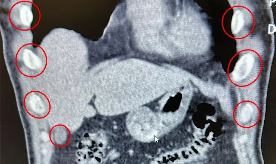 Bitlis’te düzenlenen narkotik operasyonunda yabancı uyruklu iki şüpheli, midelerinde taşıdıkları