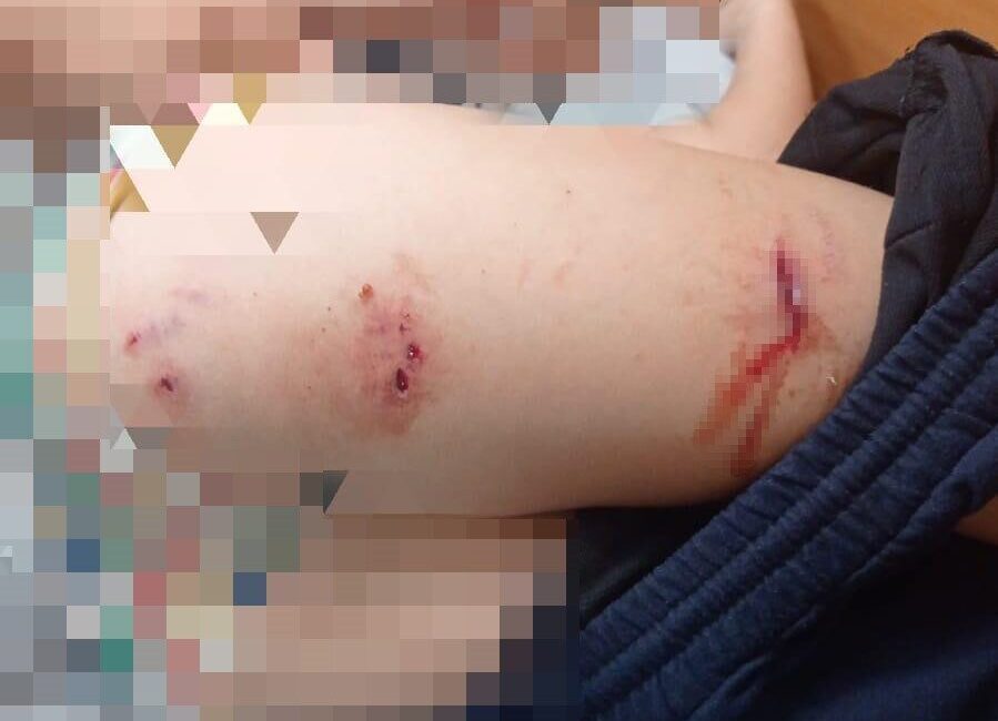 DİYARBAKIR (İHA) – Diyarbakır’da sokak köpeklerinin saldırısı sonucu 9 yaşındaki