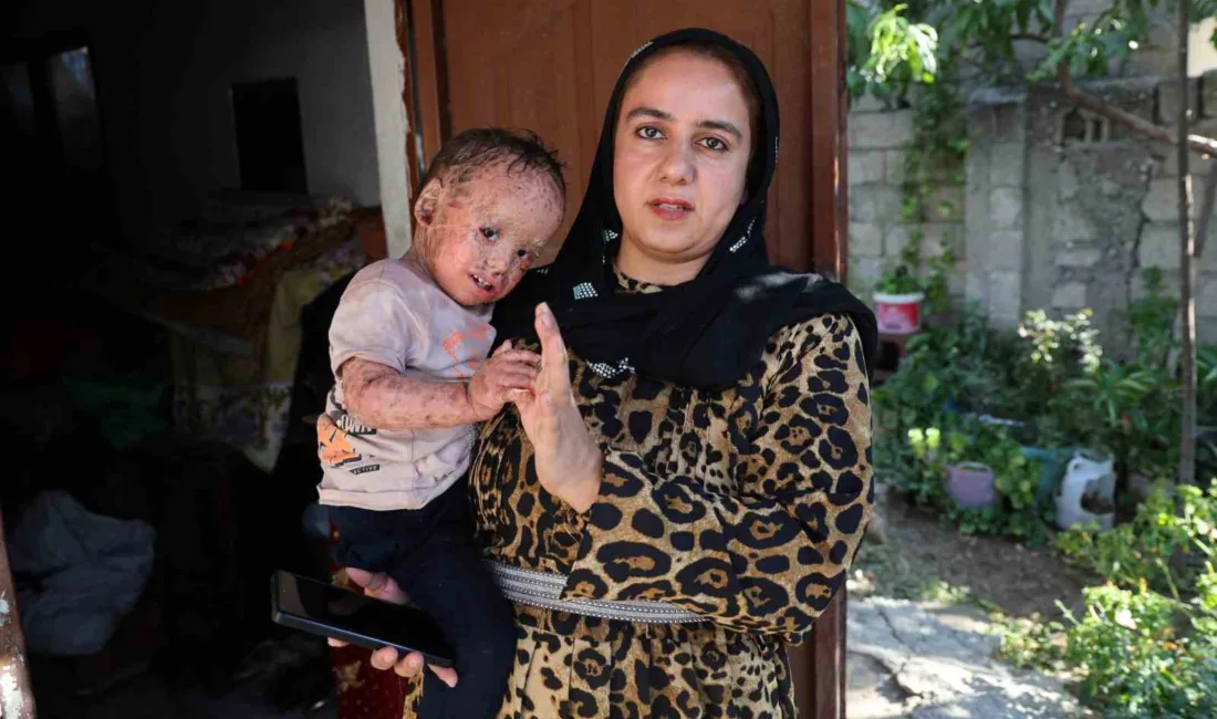 Adana’da tedavi gören balık pulu ve kelebek hastası 2 yaşındaki