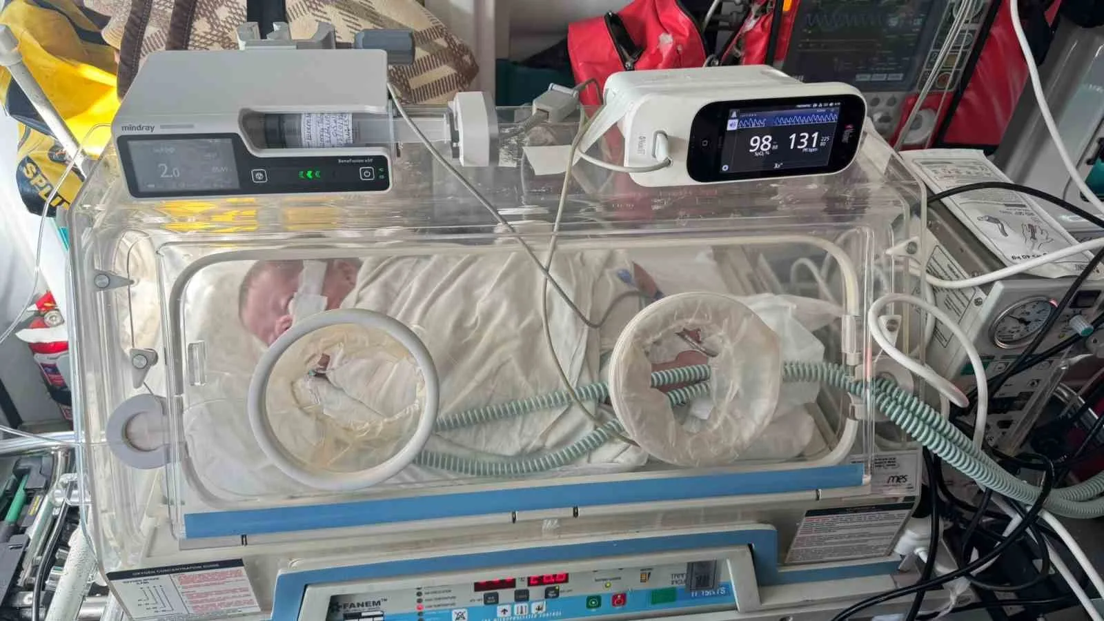 Ankara Bilkent Şehir Hastanesi’nde 170 gündür tedavi gören ve entübe