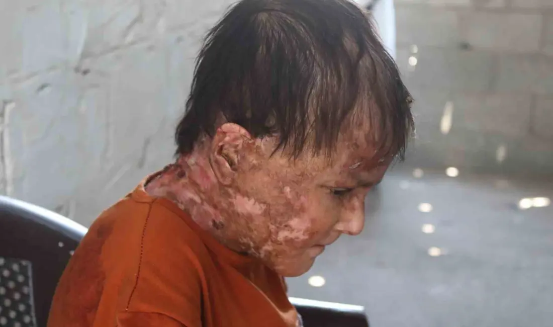 Gazze Şeridi’nde nadir bir cilt hastalığı olan halk arasında “Kelebek