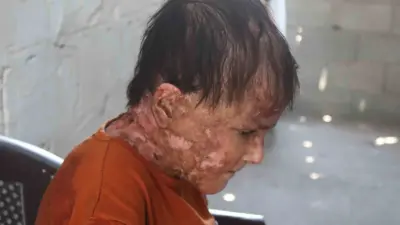 Gazze Şeridi’nde nadir bir cilt hastalığı olan halk arasında “Kelebek